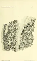 Picture 2 of 6 from Das Sarkom des Auges [electronic resource] (1900), leaf 319