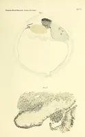 An illustration from Das Sarkom des Auges [electronic resource] (1900)