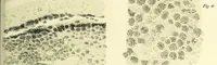 An illustration from Das Sarkom des Auges [electronic resource] (1900)