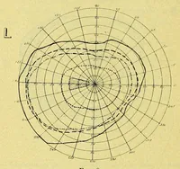 Picture 8 of 9 from Remarks on the field of vision in certain cases of "neglected eyes" / by G. E. de Schweinitz. (1895), leaf 12