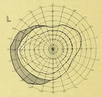 An illustration from Remarks on the field of vision in certain cases of "neglected eyes" / by G. E. de Schweinitz. (1895)