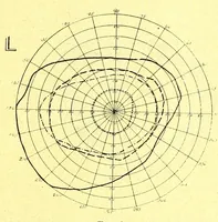Picture 3 of 9 from Remarks on the field of vision in certain cases of "neglected eyes" / by G. E. de Schweinitz. (1895), leaf 7