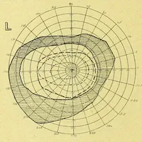 An illustration from Remarks on the field of vision in certain cases of "neglected eyes" / by G. E. de Schweinitz. (1895)