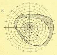 Picture 5 of 9 from Remarks on the field of vision in certain cases of "neglected eyes" / by G. E. de Schweinitz. (1895), leaf 9