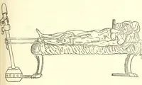 An illustration from Chirurgia (1544)