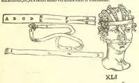 An illustration from Chirurgia (1544)
