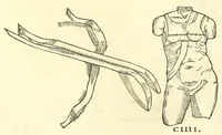 An illustration from Chirurgia (1544)