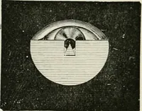 An illustration from The clinical use of prisms; and the decentering of lenses (1893)
