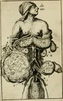 An illustration from Collectanea medico-physica, oft, Hollands jaar-register der genees- en natuur-kundige aanmerkingen van gantsch Europa &c. : beginnende met het jaar MDCLXXX : door eigen ondervinding en gemeen-making van verscheide heeren en liefhebbers (1680)