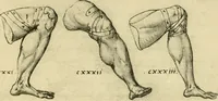 An illustration from Collection de chirurgiens grecs avec dessins attribués au Primatice. Reproduction réduite des 200 dessins du Manuscrit latin 6866 de la Bibliothèque nationale (1908)