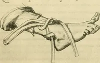 Picture 144 of 195 from Collection de chirurgiens grecs avec dessins attribués au Primatice. Reproduction réduite des 200 dessins du Manuscrit latin 6866 de la Bibliothèque nationale (1908), leaf 152