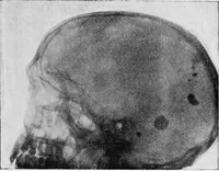 An illustration from X rays (1918)