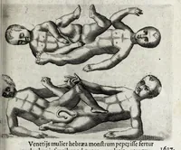 Picture 14 of 26 from De monstrorum caussis, natura, et differentiis libri duo : in quibus ex rei natura monstrorum historiae, caussae, generationes, & differentiae plurimae a sapientibus intactae : cum generatim & in plantarum, & belluarum genere, tum seorsum in humana specie tractantur : multis illustrium autorum locis difficillimis explanatis de masculo parturiente, de feminis in viros mutatis, de hermaphroditorum natura, de dissimilium specierum : venere prolifica, de castratorum fecunditate, depuero lapidescente, de anomantis aurea parte, alijsque admirabilibus (1634), leaf 147