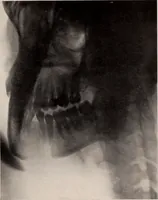 An illustration from Dental and oral radiography : a text book for students and practitioners of dentistry (1916)