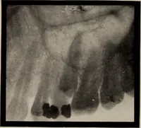 An illustration from Dental and oral radiography : a text book for students and practitioners of dentistry (1916)