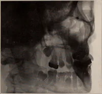 An illustration from Dental and oral radiography : a text book for students and practitioners of dentistry (1916)