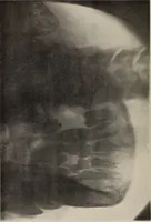 An illustration from Dental and oral radiography : a text book for students and practitioners of dentistry (1916)
