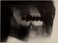 An illustration from Dental and oral radiography : a text book for students and practitioners of dentistry (1916)