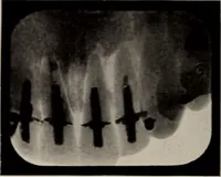 An illustration from Dental and oral radiography : a text book for students and practitioners of dentistry (1916)