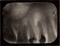 An illustration from Dental and oral radiography : a text book for students and practitioners of dentistry (1916)