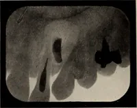 An illustration from Dental and oral radiography : a text book for students and practitioners of dentistry (1916)