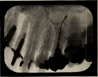 An illustration from Dental and oral radiography : a text book for students and practitioners of dentistry (1916)