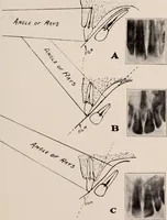 An illustration from Dental and oral radiography : a text book for students and practitioners of dentistry (1916)
