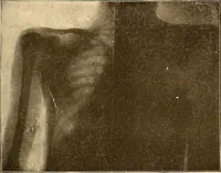 Picture 93 of 95 from Die Einrichtungen zur Erzeugung der Roentgenstrahlen und ihr Gebrauch : gemeinfasslich dargestellt insbesondere auch für Ärzte und Kliniken (1899), leaf 151