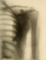 An illustration from Die Einrichtungen zur Erzeugung der Roentgenstrahlen und ihr Gebrauch : gemeinfasslich dargestellt insbesondere auch für Ärzte und Kliniken (1899)