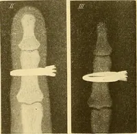 Picture 95 of 95 from Die Einrichtungen zur Erzeugung der Roentgenstrahlen und ihr Gebrauch : gemeinfasslich dargestellt insbesondere auch für Ärzte und Kliniken (1899), leaf 160