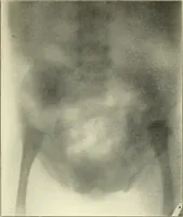 An illustration from Die Röntgenstrahlen im Dienste der Chirurgie (1902)