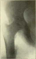 An illustration from Die Röntgenstrahlen im Dienste der Chirurgie (1902)