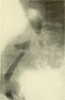 An illustration from Die Röntgenstrahlen im Dienste der Chirurgie (1902)