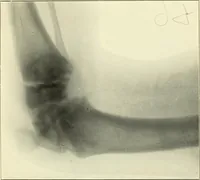 An illustration from Die Röntgenstrahlen im Dienste der Chirurgie (1902)