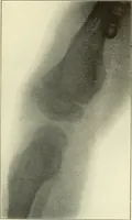 An illustration from Die Röntgenstrahlen im Dienste der Chirurgie (1902)