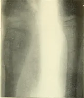 An illustration from Die Röntgenstrahlen im Dienste der Chirurgie (1902)