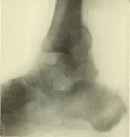 An illustration from Die Röntgenstrahlen im Dienste der Chirurgie (1902)