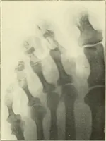 An illustration from Die Röntgenstrahlen im Dienste der Chirurgie (1902)