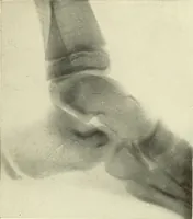 An illustration from Die Röntgenstrahlen im Dienste der Chirurgie (1902)
