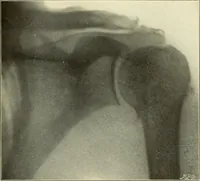 An illustration from Die Röntgenstrahlen im Dienste der Chirurgie (1902)