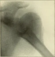 An illustration from Die Röntgenstrahlen im Dienste der Chirurgie (1902)