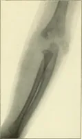 An illustration from Die Röntgenstrahlen im Dienste der Chirurgie (1902)