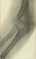 An illustration from Die Röntgenstrahlen im Dienste der Chirurgie (1902)