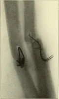 An illustration from Die Röntgenstrahlen im Dienste der Chirurgie (1902)