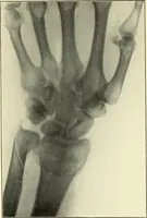 Picture 36 of 54 from Die Röntgenstrahlen im Dienste der Chirurgie (1902), leaf 194