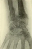 Picture 37 of 54 from Die Röntgenstrahlen im Dienste der Chirurgie (1902), leaf 196