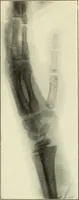 An illustration from Die Röntgenstrahlen im Dienste der Chirurgie (1902)