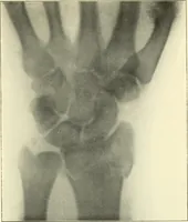 An illustration from Die Röntgenstrahlen im Dienste der Chirurgie (1902)