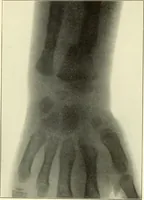 An illustration from Die Röntgenstrahlen im Dienste der Chirurgie (1902)