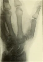 An illustration from Die Röntgenstrahlen im Dienste der Chirurgie (1902)